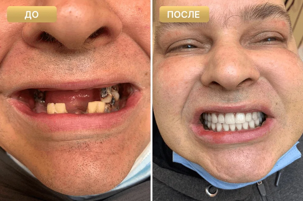 Пациент Full Clinic до и после лечения — случай 2