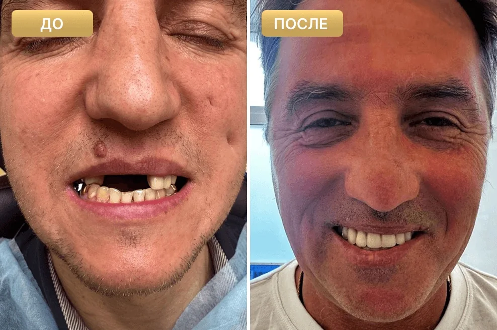Пациент Full Clinic до и после лечения — случай 3