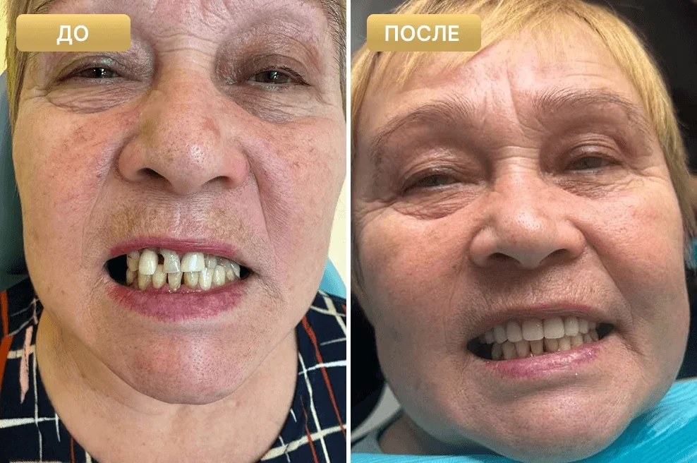 Пациент Full Clinic до и после лечения — случай 4