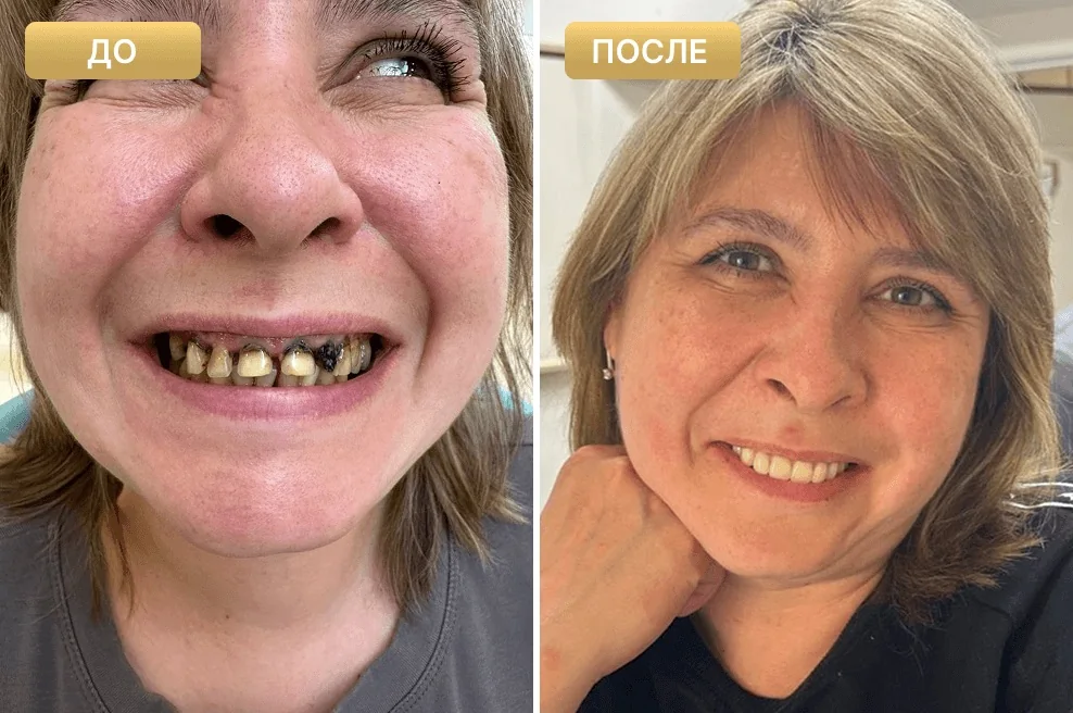 Пациент Full Clinic до и после лечения — случай 5